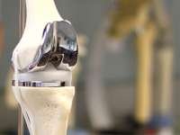 Personalize your knee replacement!