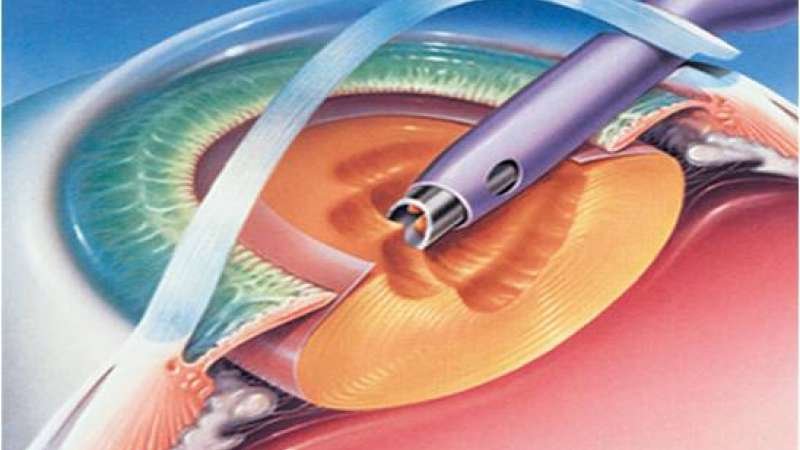 Phacoemulsification systems gaining popularity